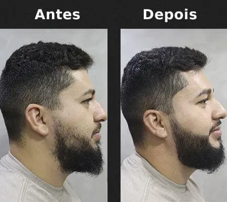 Preenchedor de Falhas na Barba Antes e depois 2