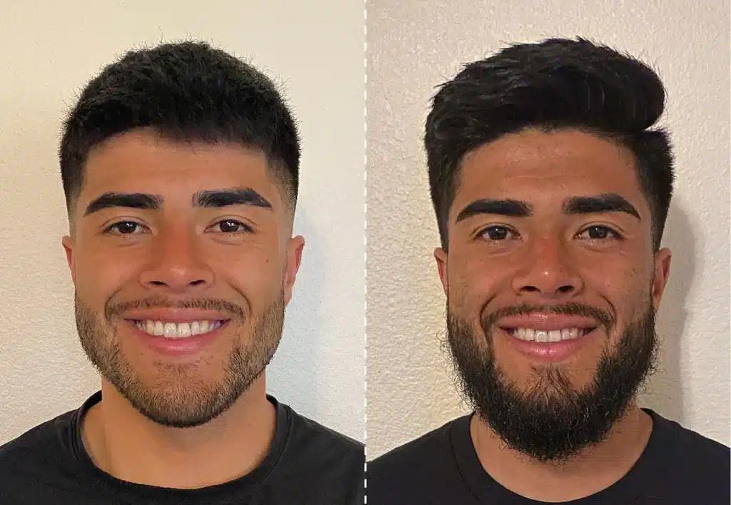 dermaroller na barba antes e depois