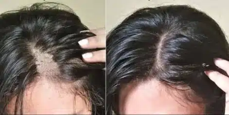 resultado no cabelo de mulher