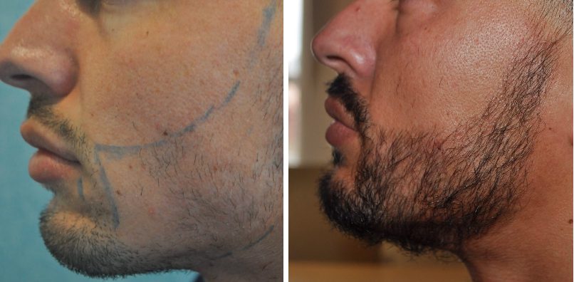 resultados na barba antes e depois